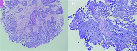 Case 1: A. Breast mass biopsy B. Primary tumor. Both sections... | Download Scientific Diagram