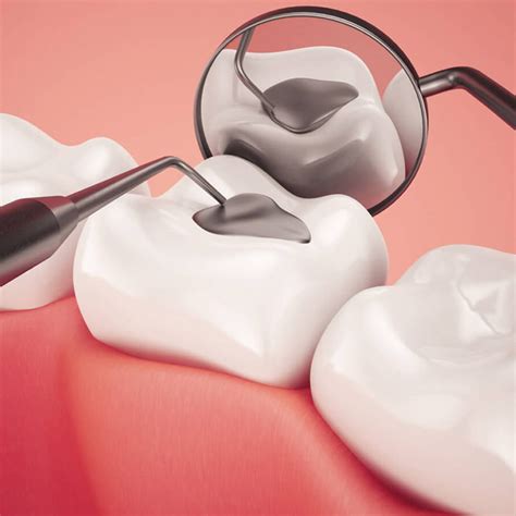 Dental Fillings - Eledent Dental Hospitals