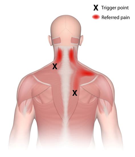 What Is A Trigger Point?