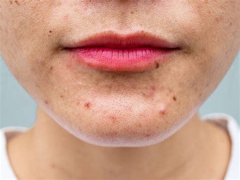 Puberty and Acne: How a Good Skincare Routine Can Help