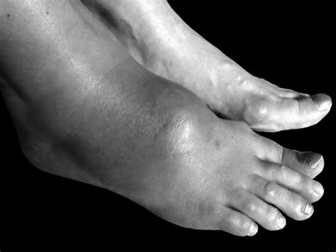 A Rare Cause of Foot Swelling Mimicking Tenosynovitis | The Journal of Rheumatology