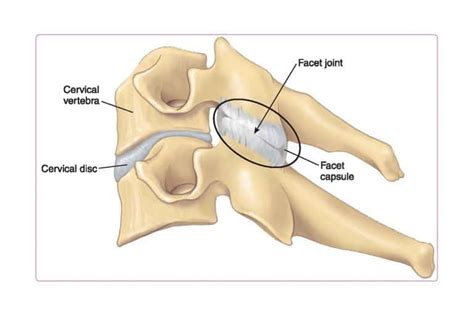 Cervical Facet Joint Syndrome | Blackberry Clinic Blog