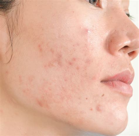 Unveiling the Mystery of Adult Acne in Women: A Comprehensive Scientific Guide - L'Amour Clinic