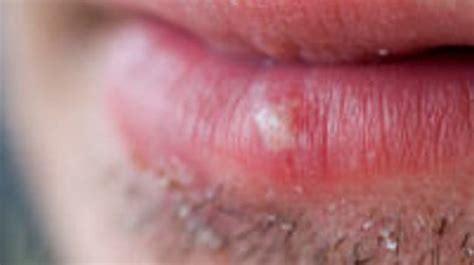 Sunburn On Lips Blisters | Lipstutorial.org