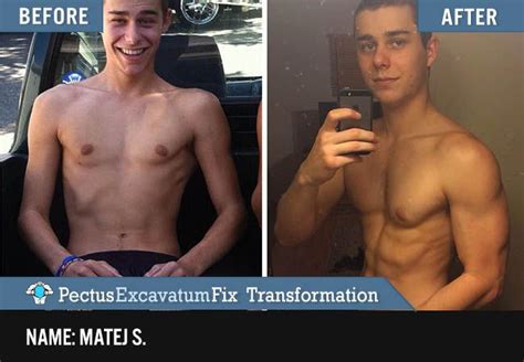 pectus excavatum before and after exercise | Pectus excavatum, Exercise, Bodybuilding workouts