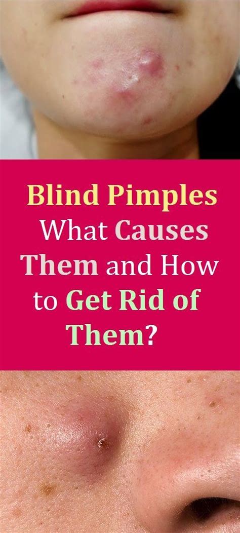 Blind Pimple On Chin Treatment ~ wallpaper andri