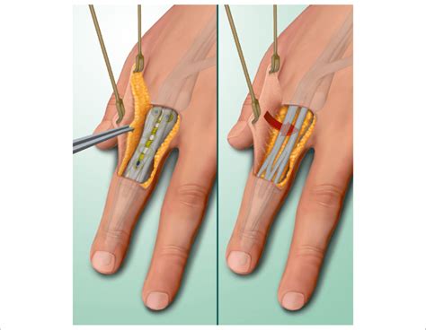 Graphic illustration of the surgical technique. | Download Scientific ...