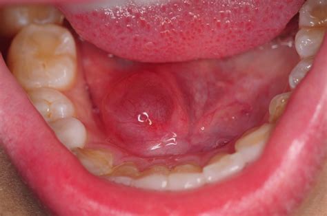 Oral Pathology | Oral Pathology - FacialartDentalForum.com