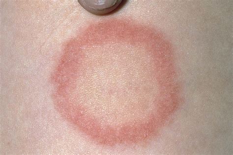 Ringworm Look Alikes Symptoms Of Ringworm Ringworm Types Of Diseases | Images and Photos finder