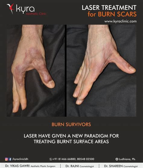 Laser for Burn Scar Surgery in Ludhiana, Punjab