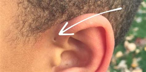 Have you seen someone with a ‘Tiny Hole’ above their ears? This is what ...