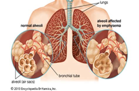 Bronchial Disorders