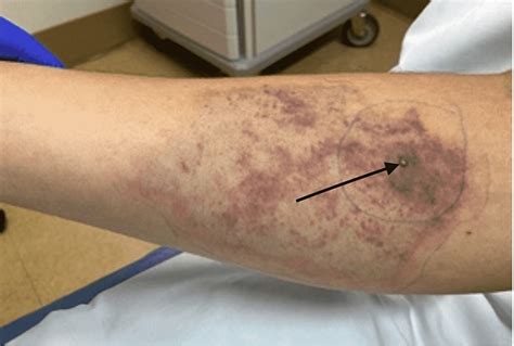 Cureus | Brown Recluse Spider Bite Resulting in Coombs Negative Hemolytic Anemia in a Young Male ...