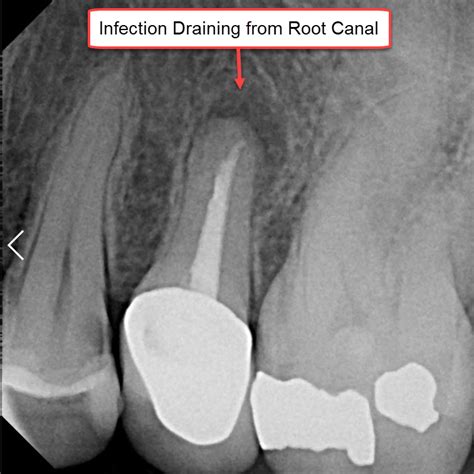 How to Resolve a Root Canal Infection - A Pardigm Shift - Integrative ...