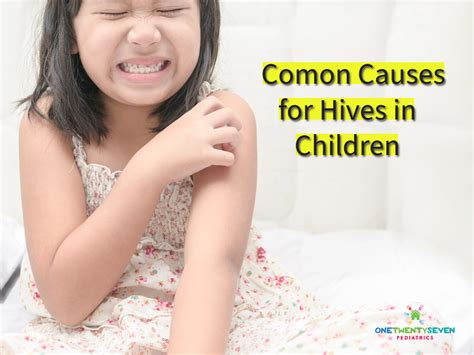 What Causes Hives in Kids Out of Nowhere? - 127 Pediatrics