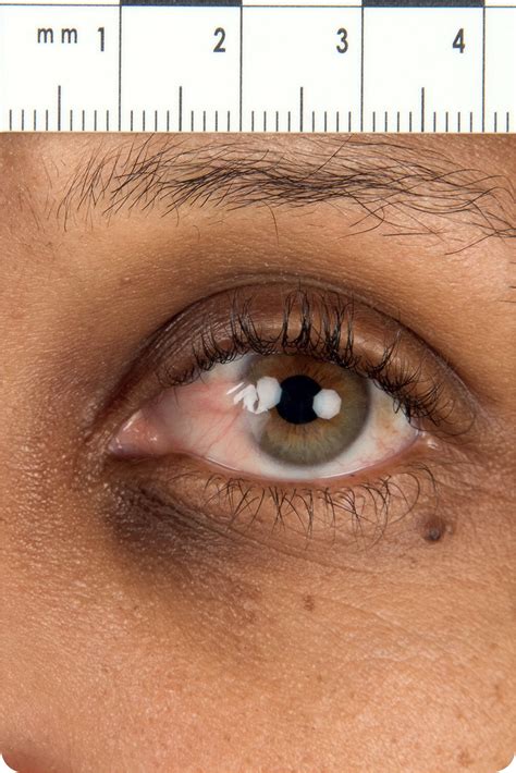 A Lesion on the Eye | AAFP