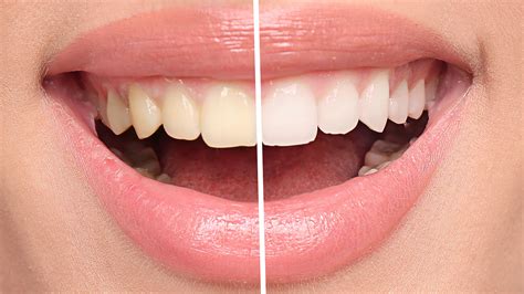 6 tips for healthy white teeth | OverSixty