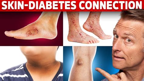 9 Diabetic Skin Problems That Indicate Diabetes - YouTube