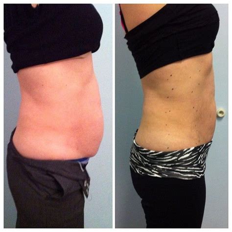 Lila Body Contouring Laser of a female abdomen, before & after # ...