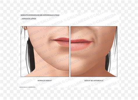 Acromegaly Face Diabetes Mellitus Lip Surgery, PNG, 600x600px, Acromegaly, Cheek, Chin ...