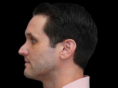 Rhinoplasty Archives - Nicholas Lahar, MD