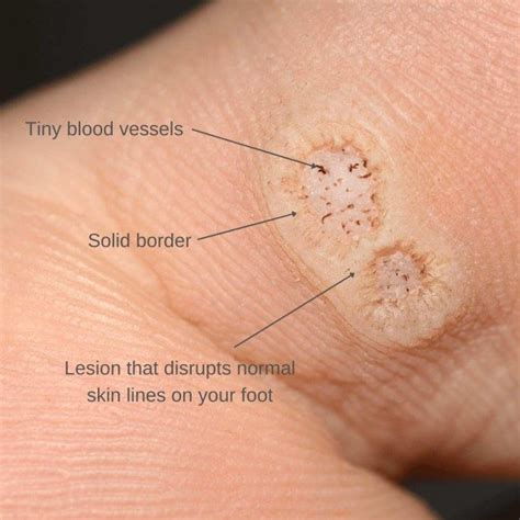 Plantar Warts: Causes, Symptoms & Treatment | The Feet People Podiatry