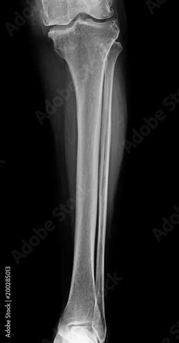 Lower leg xray , x-ray image of leg front view , xray of normal leg ...