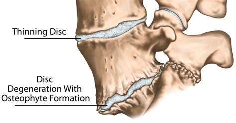 Bone Spurs of the Spine – What Causes Them and How Can They Be Treated ...