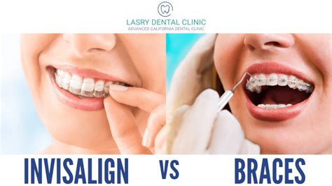 Invisalign Vs Braces Results