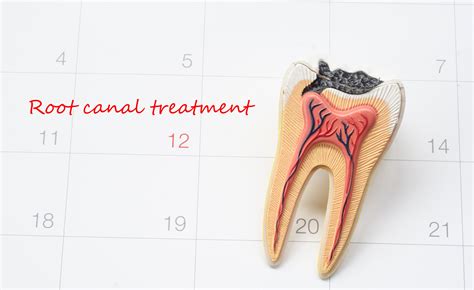 Root Canal Procedure | Who Performs it and What Does it Cost?