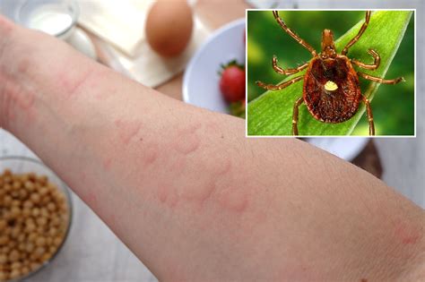 Alpha-gal syndrome alert: Warning signs for tick-borne meat allergy