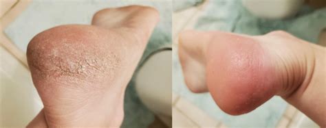 12 Best Dry Feet & Cracked Skin Remedies (Cheap & Effective Solutions!)