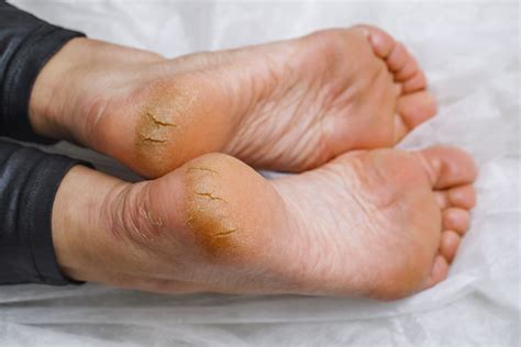 Foot Fissures – Symptoms, Causes, Treatment, Prevention & Remedies