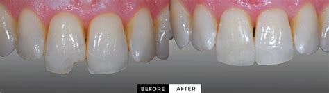 Cosmetic Dentistry Las Vegas | Composite Resin | JB White DDS