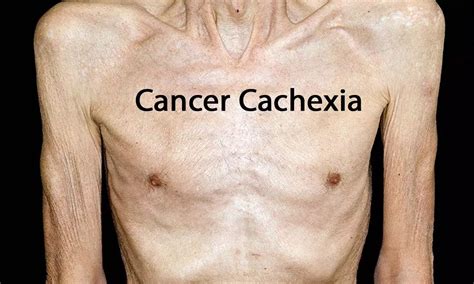 Management of Cancer Cachexia: ASCO Guideline