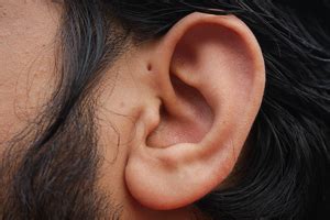 Preauricular Pits: Causes and Treatment