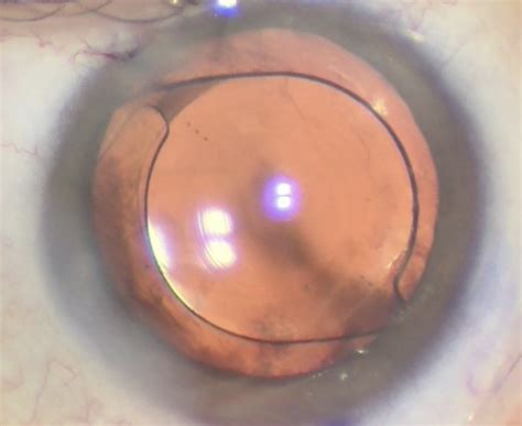 Which Lens for Which Patient?