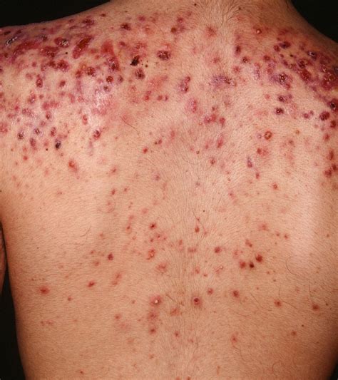 Back Acne Causes and Best Treatment to Get Rid of Back Acne and Scars