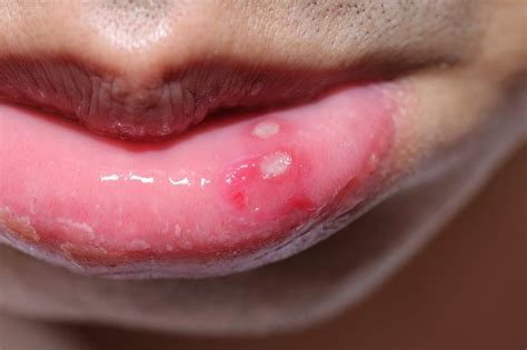 What Causes Sores Inside Lips | Lipstutorial.org