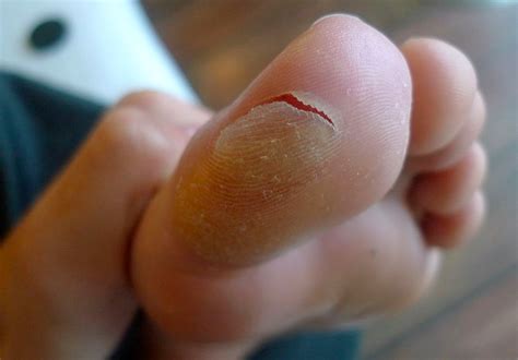 Blisters – Perform Podiatry