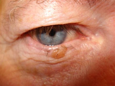 Seborrheic Keratosis Eyelid