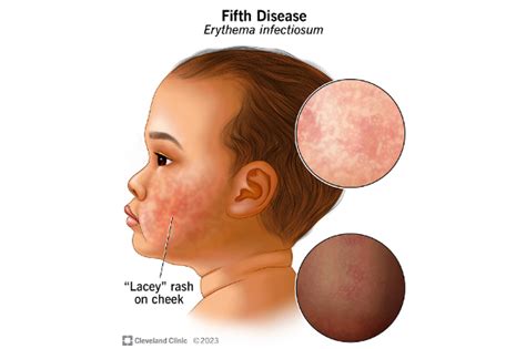 Parvovirus: ‘Slapped cheek’ rash-causing virus on the rise among kids, CDC warns | The Independent