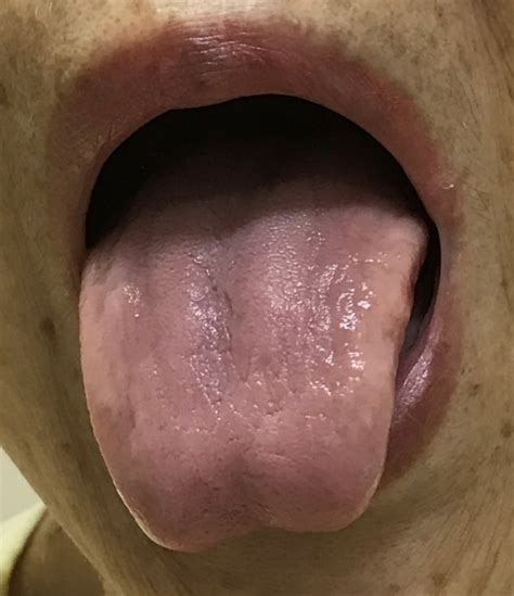 Papillary atrophy of the tongue - Niimi - 2018 - Clinical Case Reports - Wiley Online Library