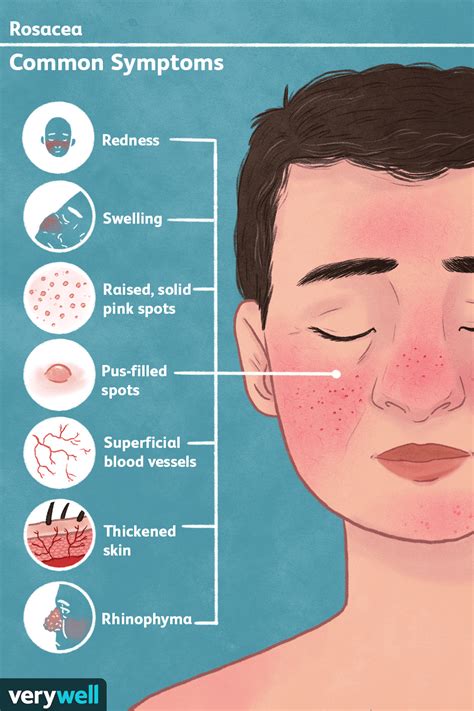 Rosacea: Signs, Symptoms, and Complications