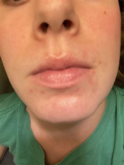 [acne] scars from 6+ months ago - help!! : r/SkincareAddiction