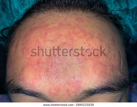 Urticaria Rash Allergic Reaction On Forehead 庫存照片 1884231838 | Shutterstock