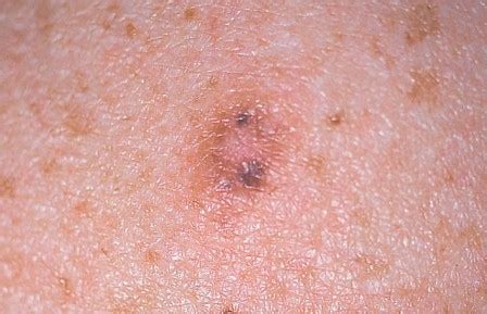 Desmoplastic melanoma - Il Melanoma