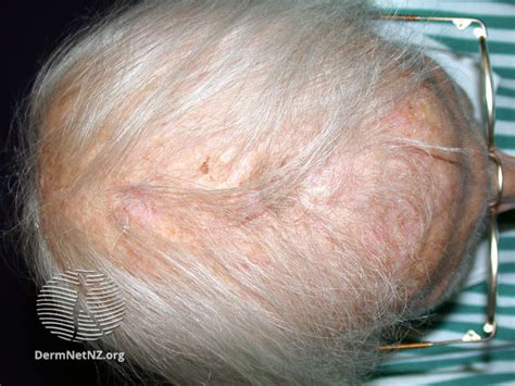 Androgenetic Alopecia (Female) - The London Skin And Hair Clinic