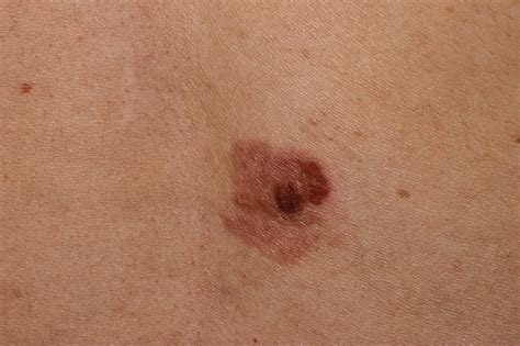 Benign Nevus Vs Melanoma