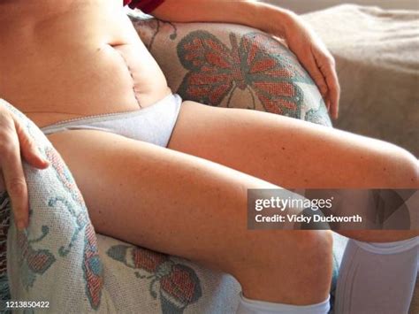 14 Hysterectomy Scar Stock Photos, High-Res Pictures, and Images - Getty Images